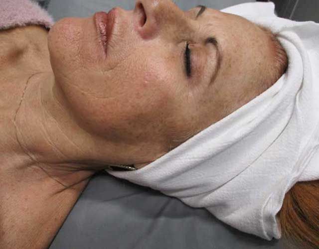 Sun Damage Before & After