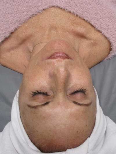 Sun Damage Before & After