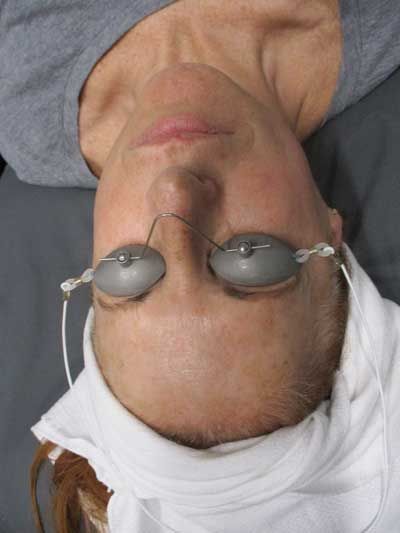 Sun Damage Before & After