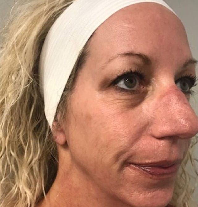 Sun Damage Before & After