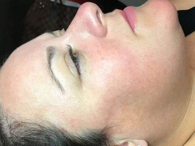 Sun Damage Before & After