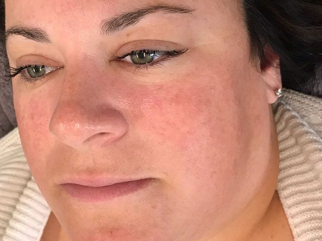 Sun Damage Before & After