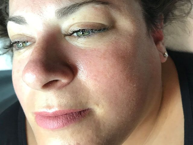 Sun Damage Before & After