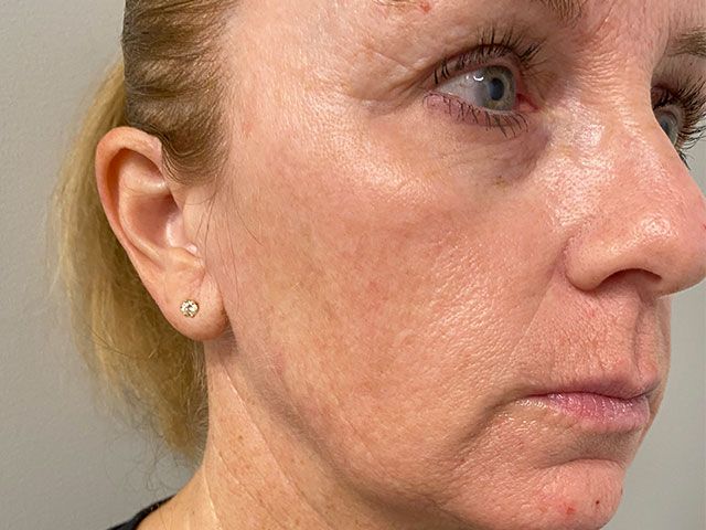 Sun Damage Before & After