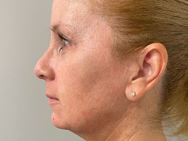 Sun Damage Before & After