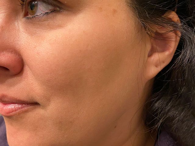 Sun Damage Before & After