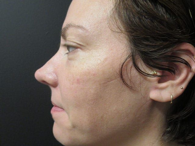 Sun Damage Before & After