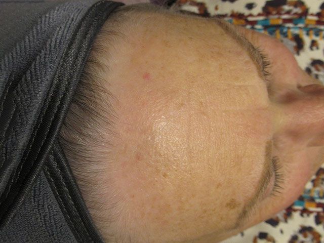 Sun Damage Before & After