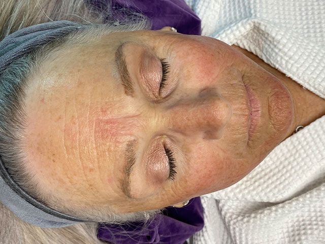 Sun Damage Before & After