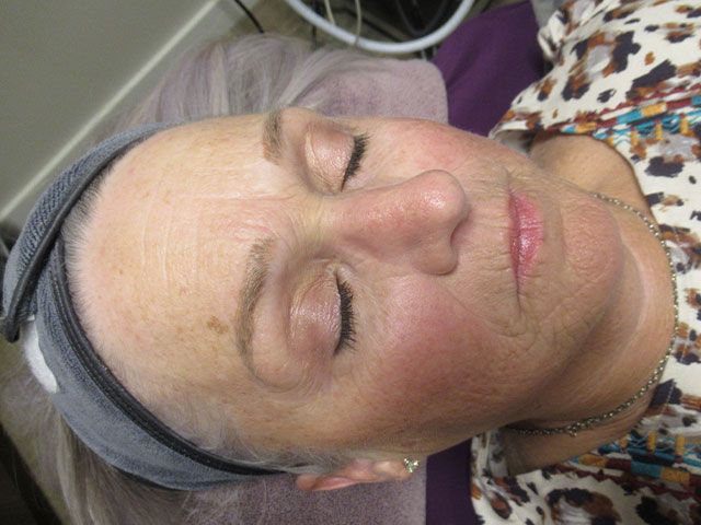 Sun Damage Before & After