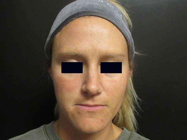 Sun Damage Before & After