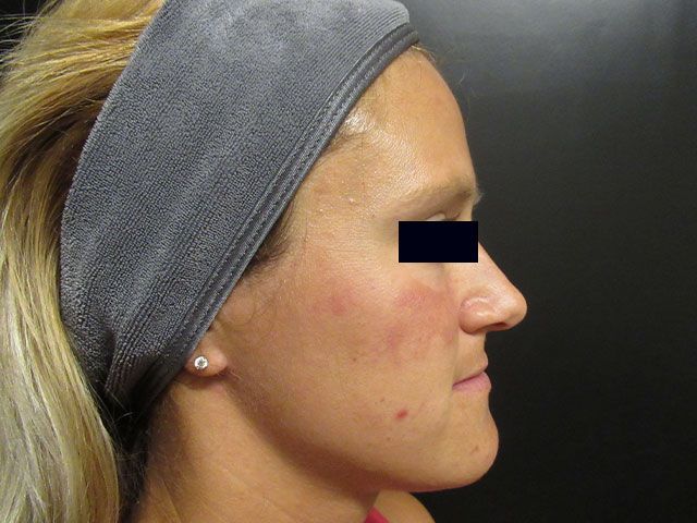 Sun Damage Before & After