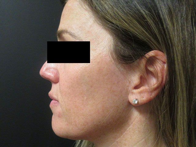 Sun Damage Before & After