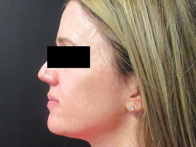 Sun Damage Before & After