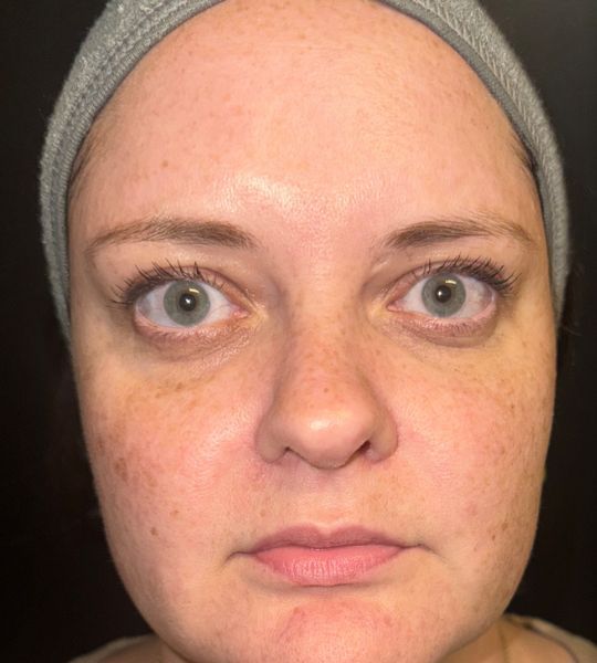 Sun Damage Before & After