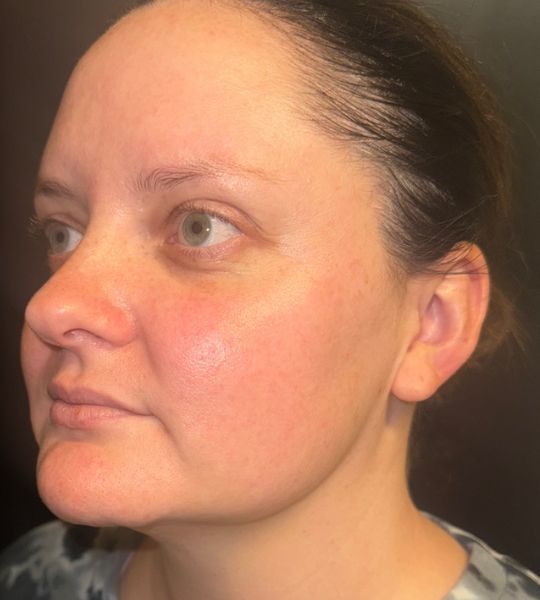 Sun Damage Before & After