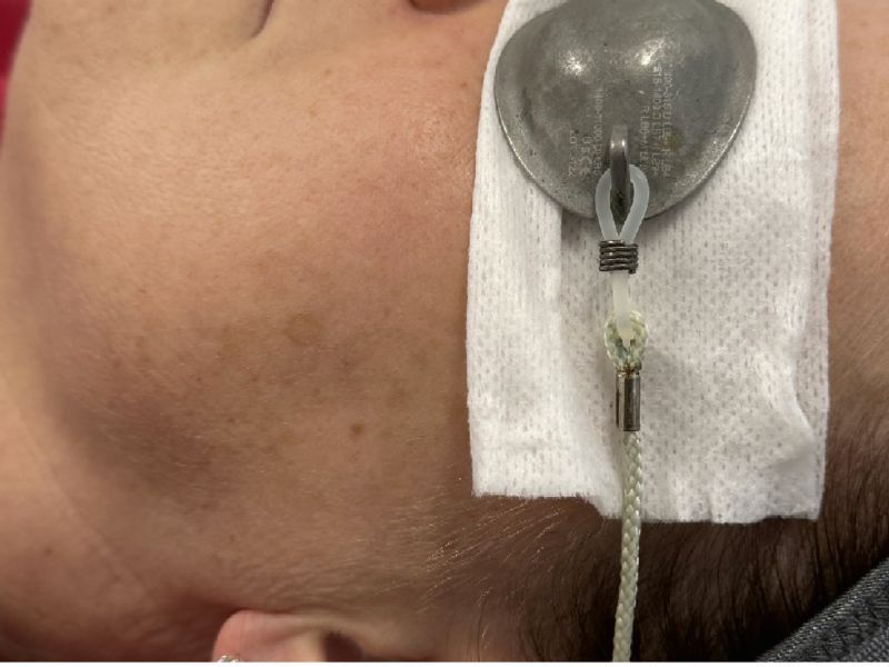 Sun Damage Before & After