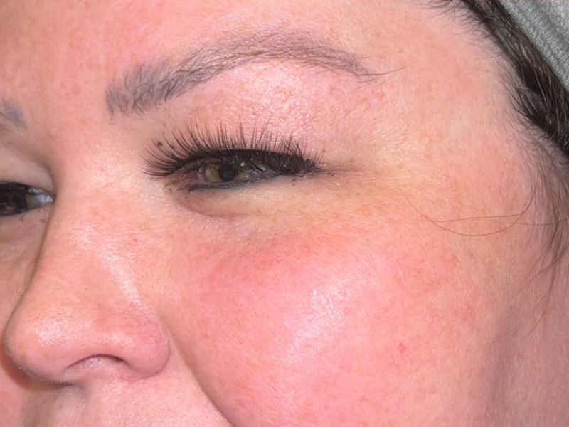 Sun Damage Before & After