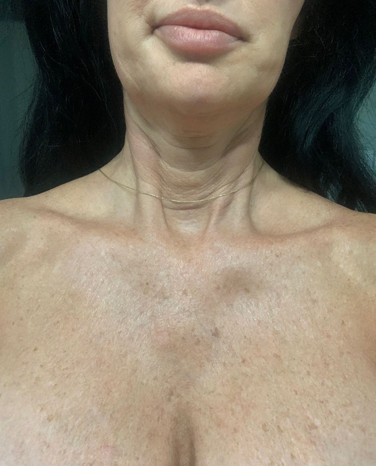 Sun Damage Before & After