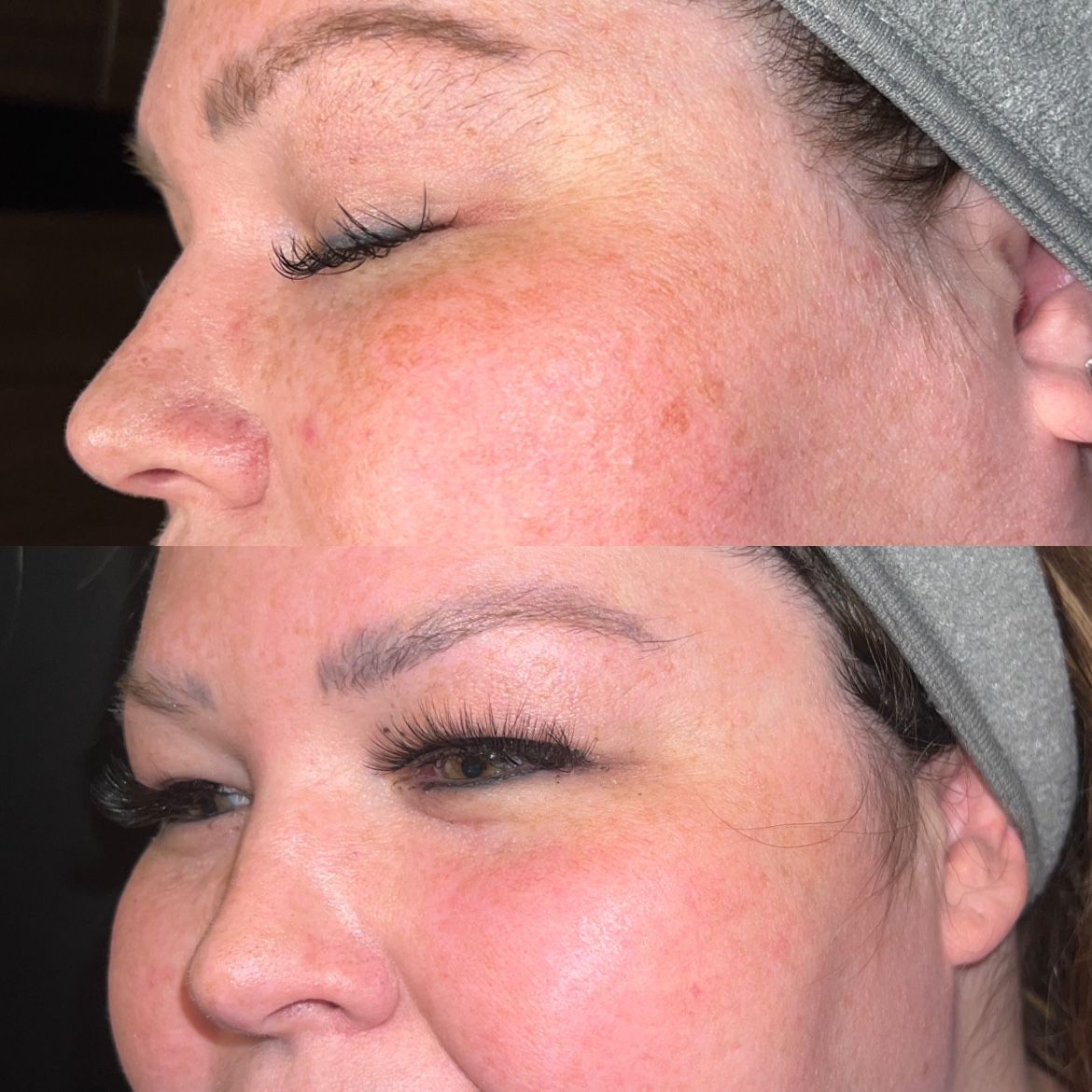 Sun Damage Before & After