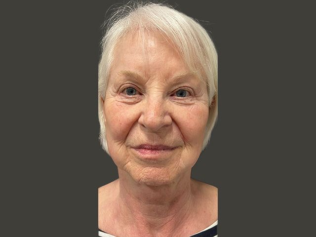 Liquid Facelift Before & After