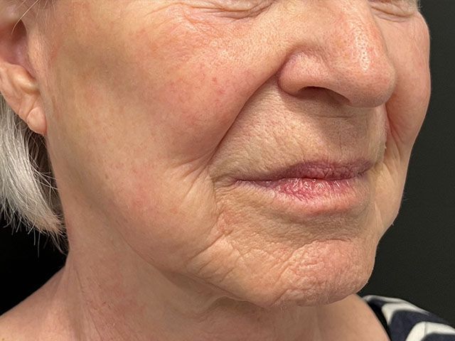 Liquid Facelift Before & After