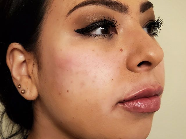 Liquid Facelift Before & After