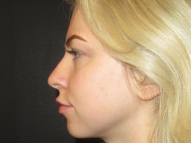 Liquid Facelift Before & After