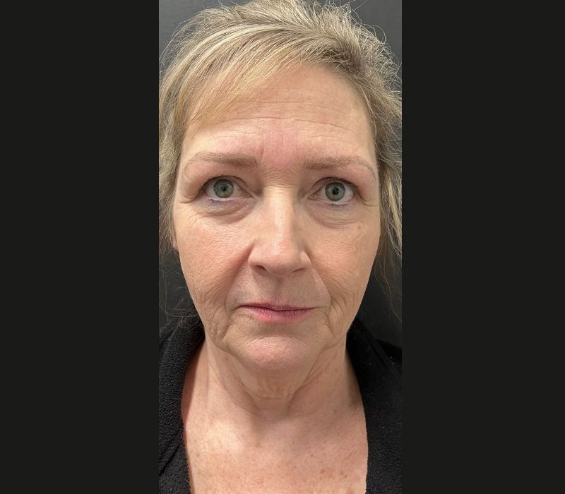 Liquid Facelift Before & After