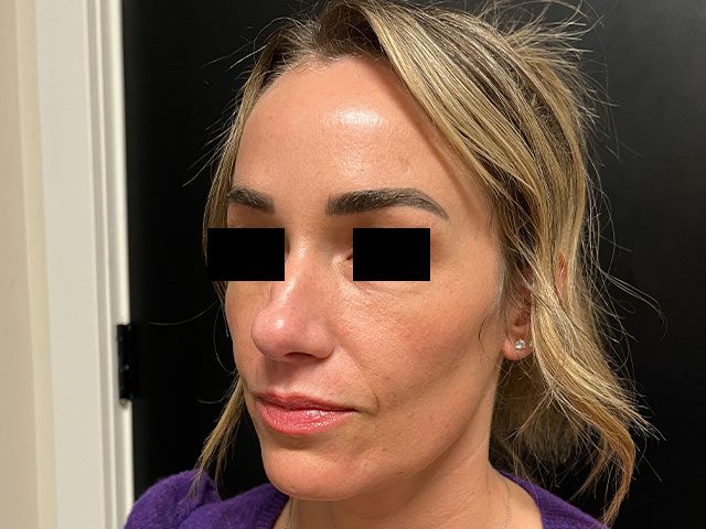 Liquid Facelift Before & After