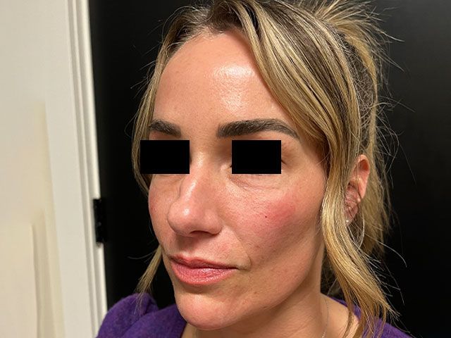 Liquid Facelift Before & After