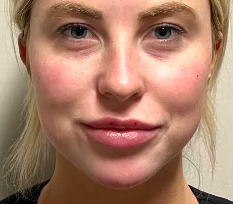 Liquid Facelift Before & After