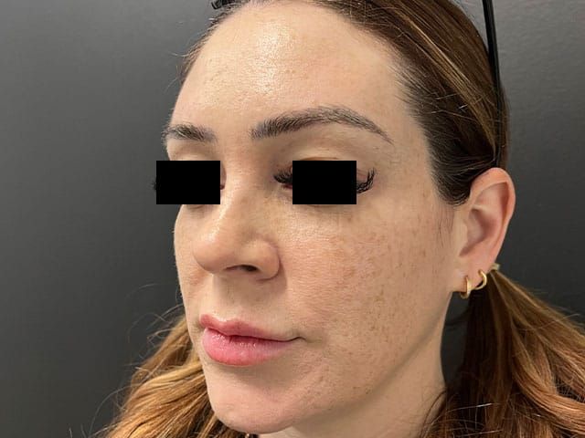 Liquid Facelift Before & After