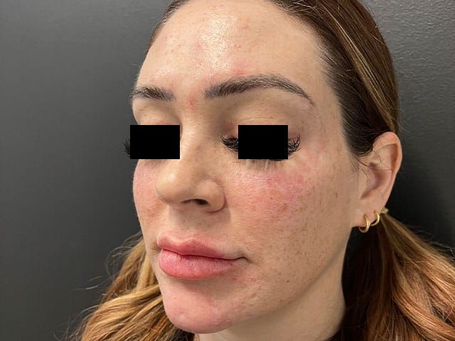 Liquid Facelift Before & After