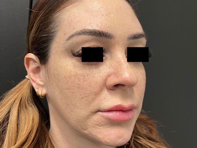 Liquid Facelift Before & After