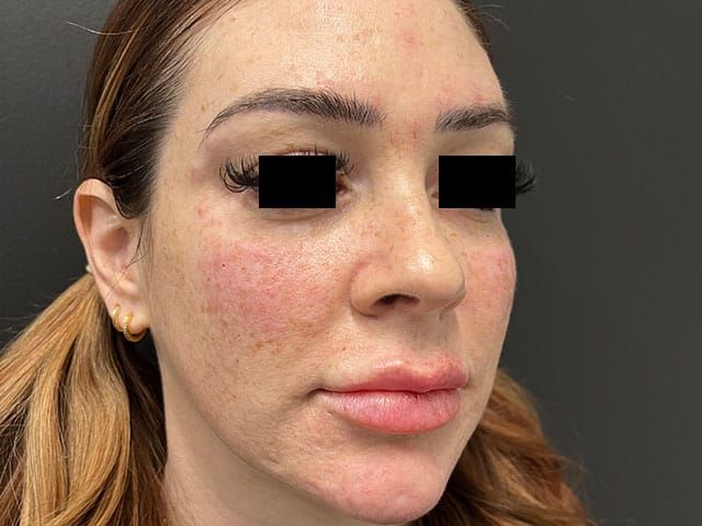 Liquid Facelift Before & After