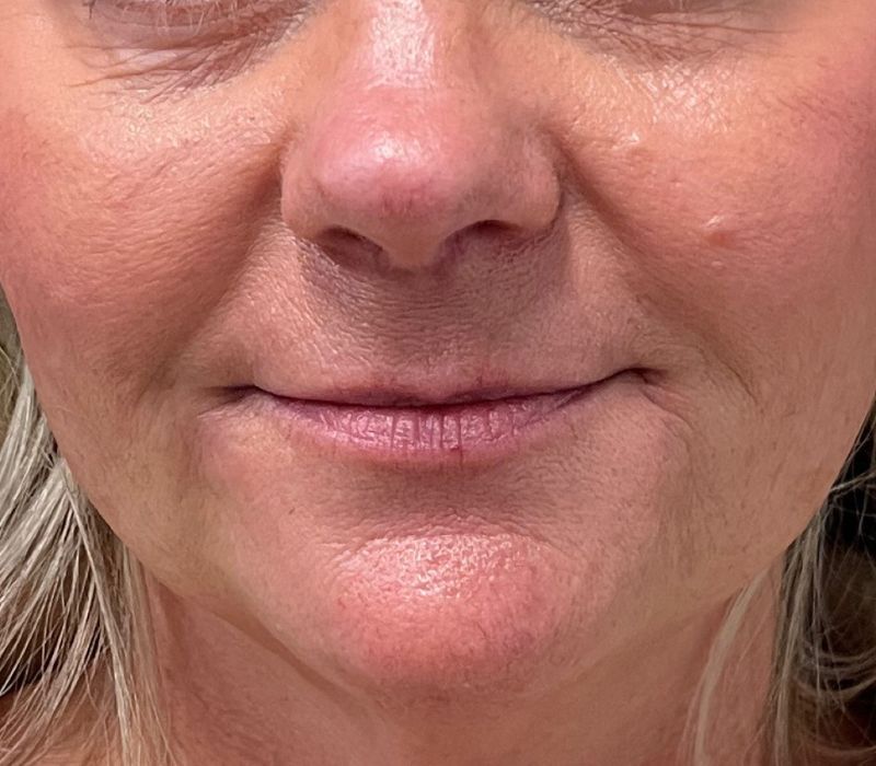Liquid Facelift Before & After