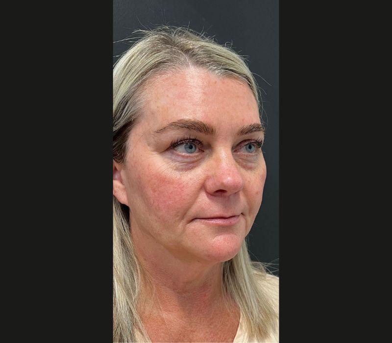 Liquid Facelift Before & After