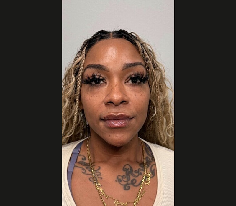 Liquid Facelift Before & After