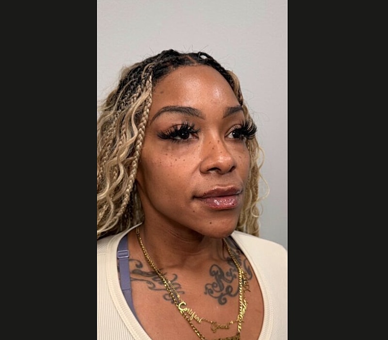 Liquid Facelift Before & After