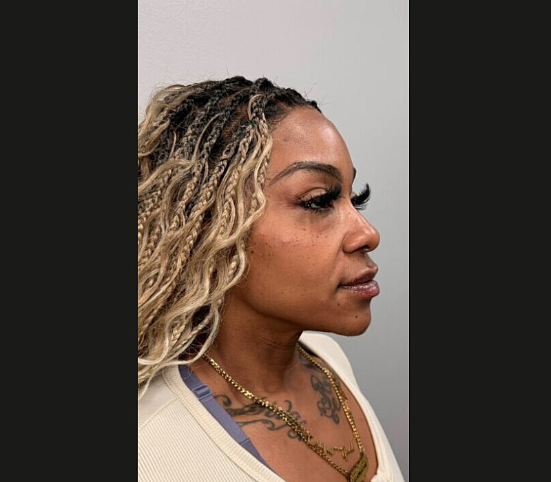 Liquid Facelift Before & After