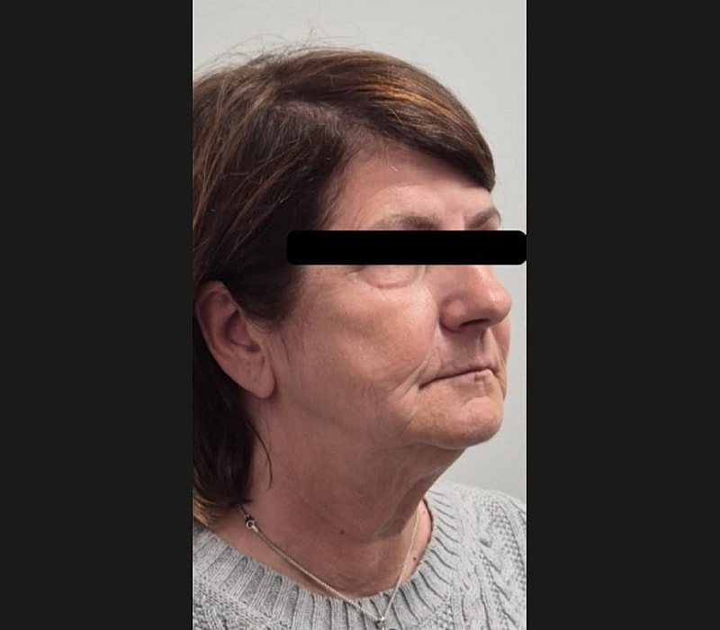 Liquid Facelift Before & After