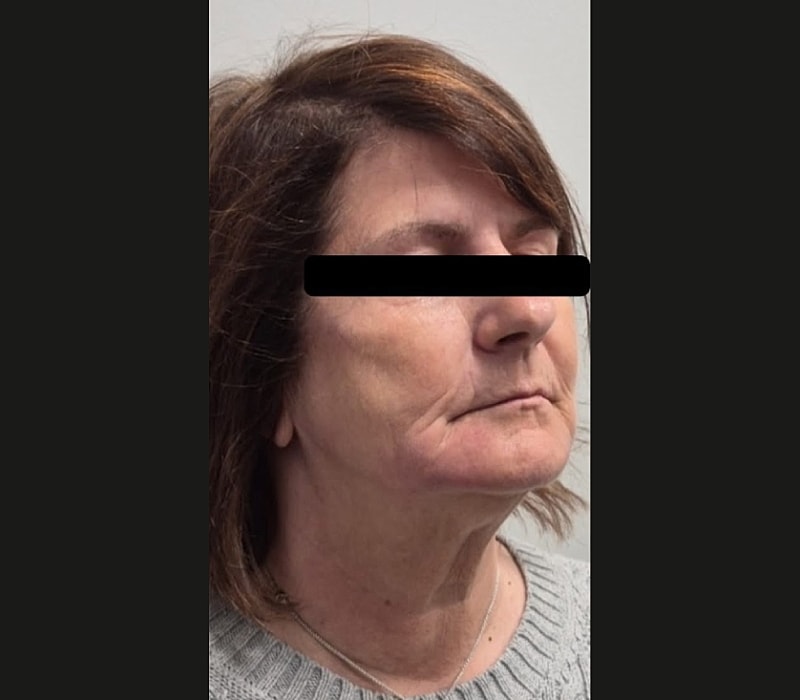 Liquid Facelift Before & After
