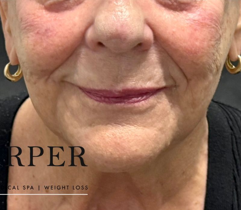 Liquid Facelift Before & After