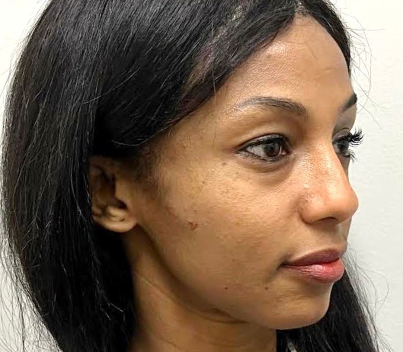 Liquid Facelift Before & After