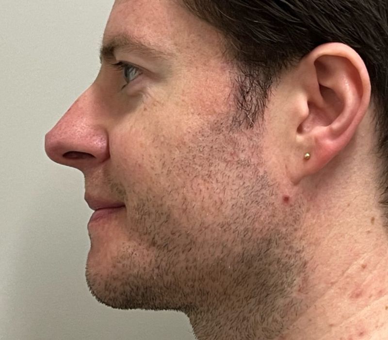 Liquid Facelift Before & After