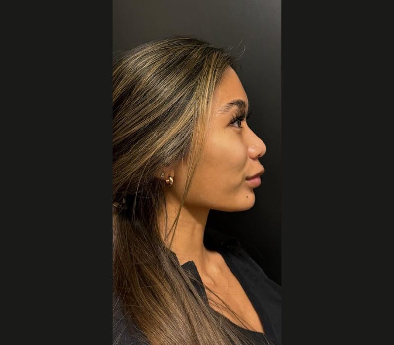 Liquid Facelift Before & After