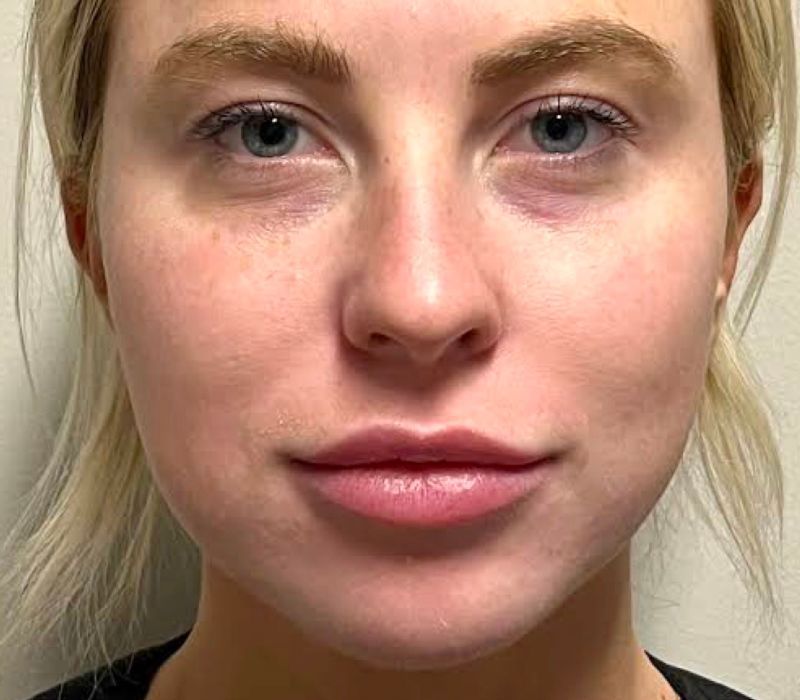 Liquid Facelift Before & After