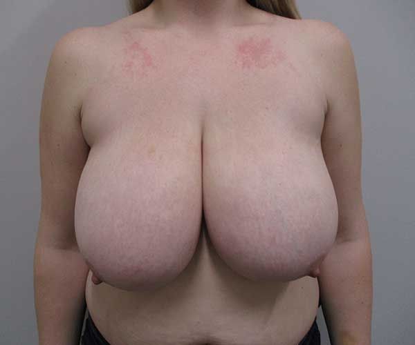 Breast Reduction Before & After