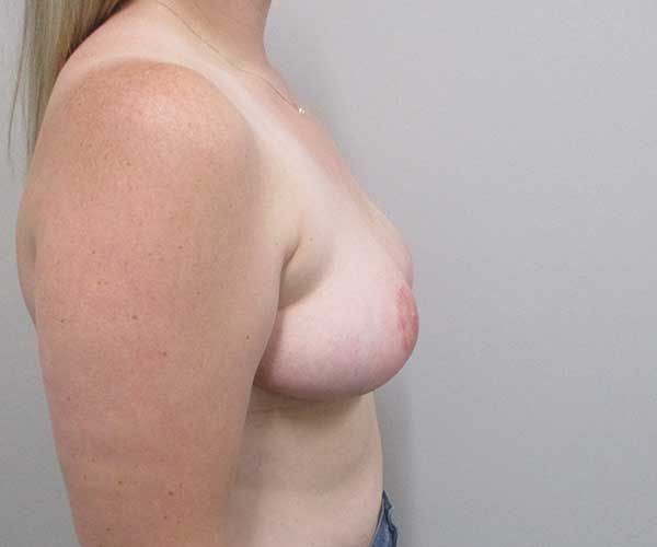 Breast Reduction Before & After